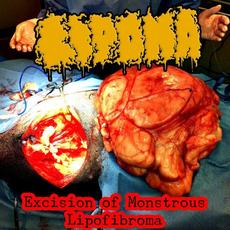 Excision Of Monstrous Lipofibroma mp3 Album by Lipoma